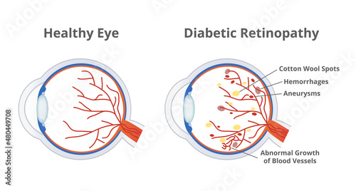 Vector illustration of diabetic retinopathy, a complication of diabetes caused by high blood sugar and normal healthy eye isolated. Cotton wool spots, hemorrhages, aneurysms, abnormal blood vessels. photo