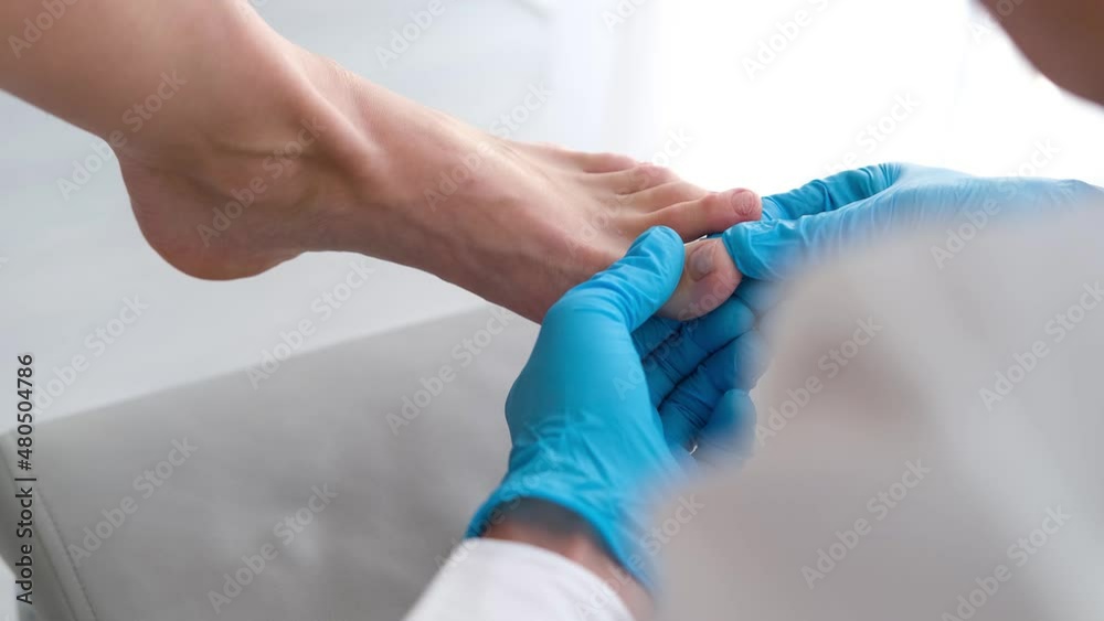 A close-up of a foot with a fungus on the nails is examined by a doctor in gloves. Onycholysis: detachment of the nail from the nail bed.