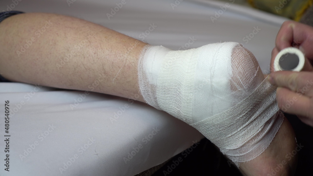 Ligation of the ankle joint with a bandage.