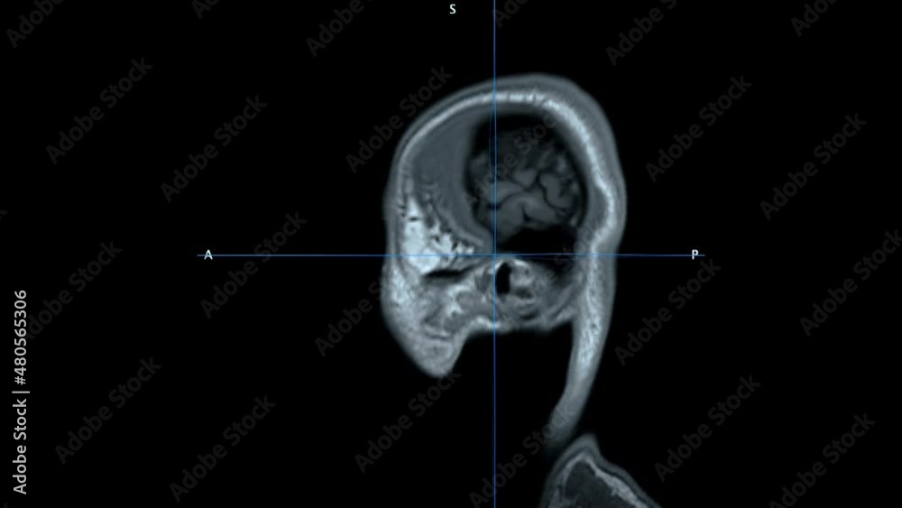 Structural T1 weighted MRI Magnetic Resonance Imaging scan of skull and brain tissue
