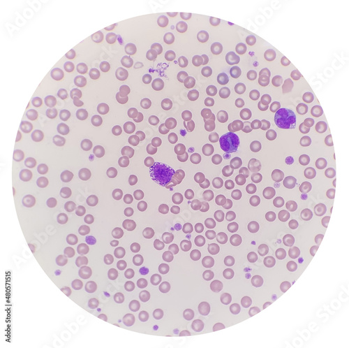 Peripheral blood showing mast cell and two monocyte. Leukocyte with a large round nucleus and numerous dark purple or blue cytoplasmic granules, mast cell.