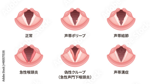 喉頭の疾患のイラスト素材セット