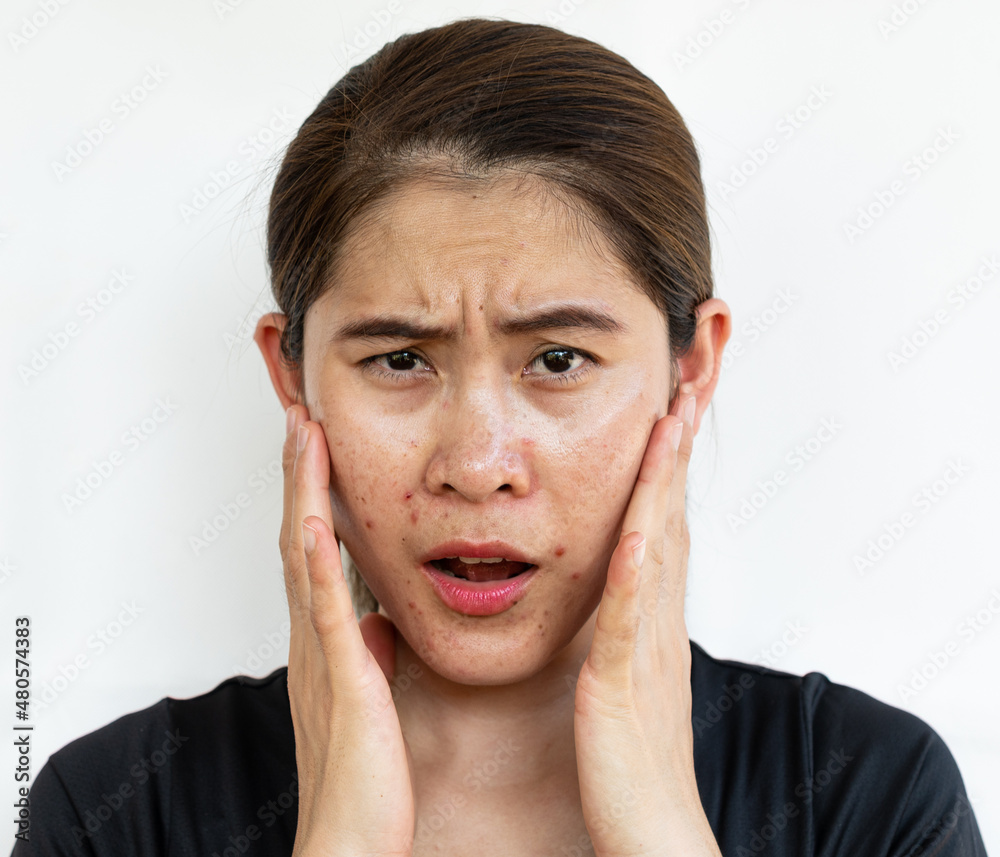 Portrait of Asian woman having problems of oily skin with acne inflamed on her face. Oily skin is the result of the overproduction of sebum from sebaceous glands.