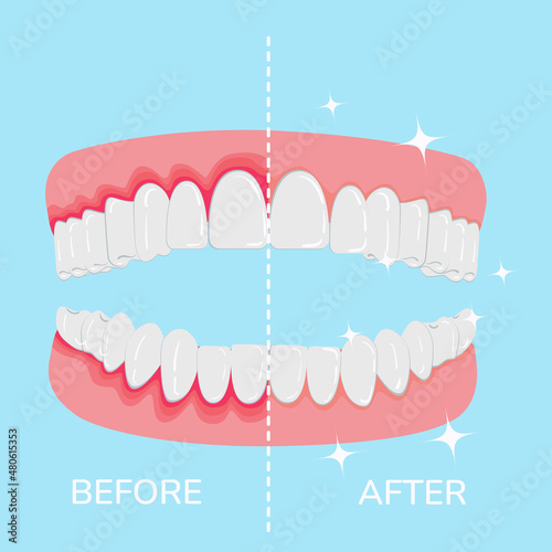 Vector of teeth and gums, healthy and affected by periodontitis.