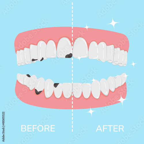 The concept of dental treatment for caries. Dentistry and stomatology vector
