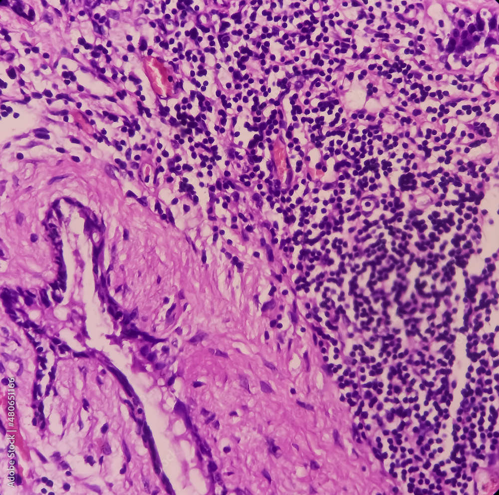 Microphotograph of Fibroadenoma with galactocele, show breast benign neoplasm, delicate