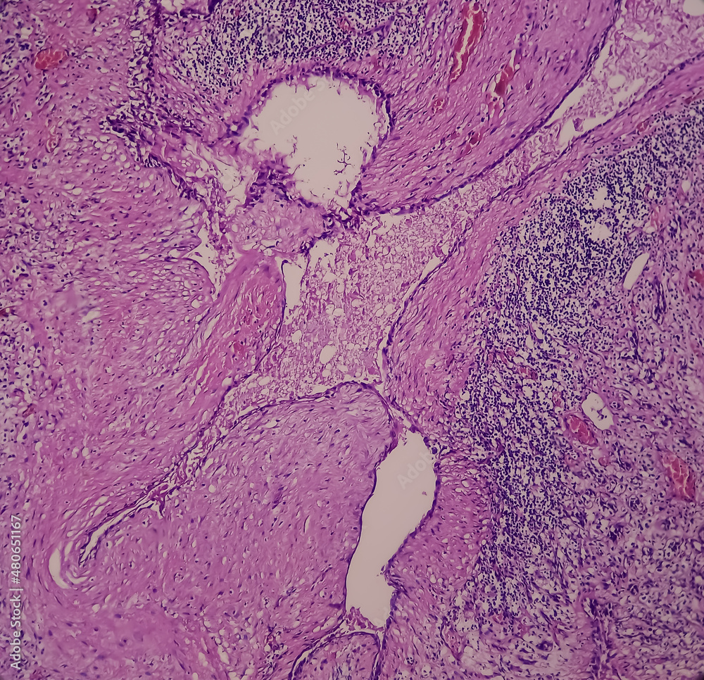 Microphotograph of Fibroadenoma with galactocele, show breast benign neoplasm, delicate