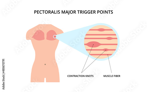Pectoralis muscle trigger point. Myofascial release physical therapy, anatomy, medicine. For topics like sport, chronic pain, massage