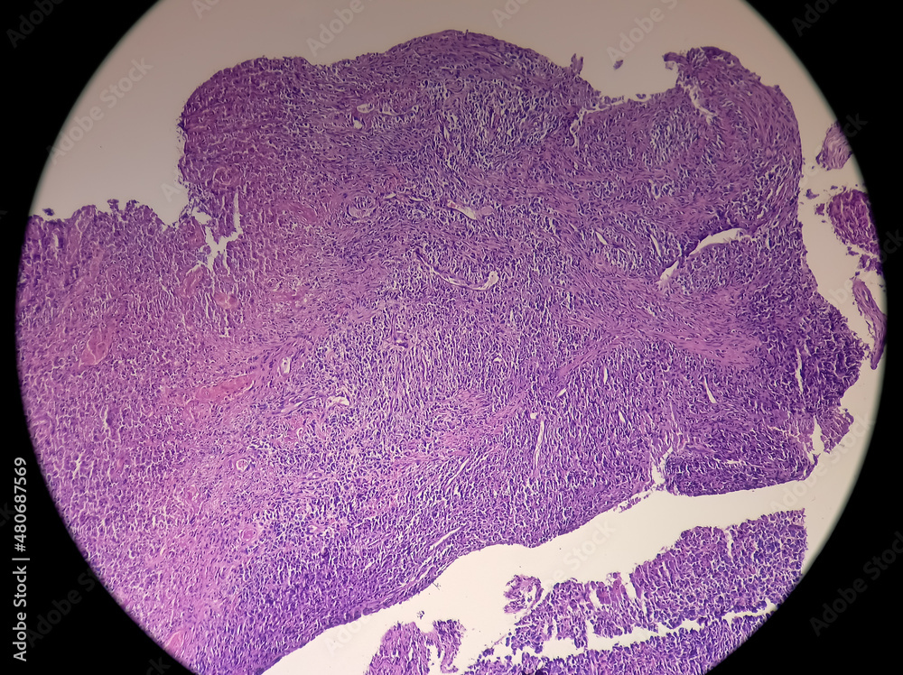Microscopic image of Colorectal carcinoma and Amelanotic melanoma. Show