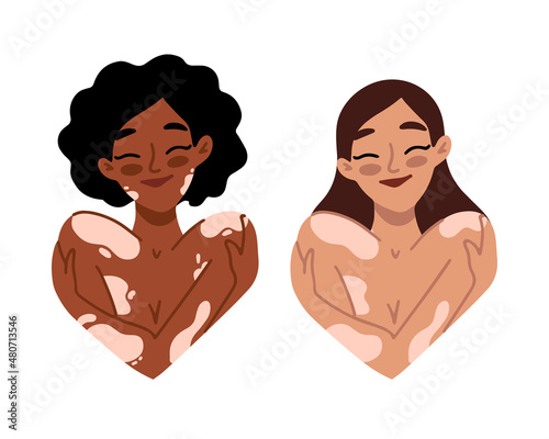 Young woman with vitiligo hugging herself. Support people with chronic skin disorder. Beauty is diversity. Self acceptance, self love concept. Poster, banner, card World Vitiligo Day