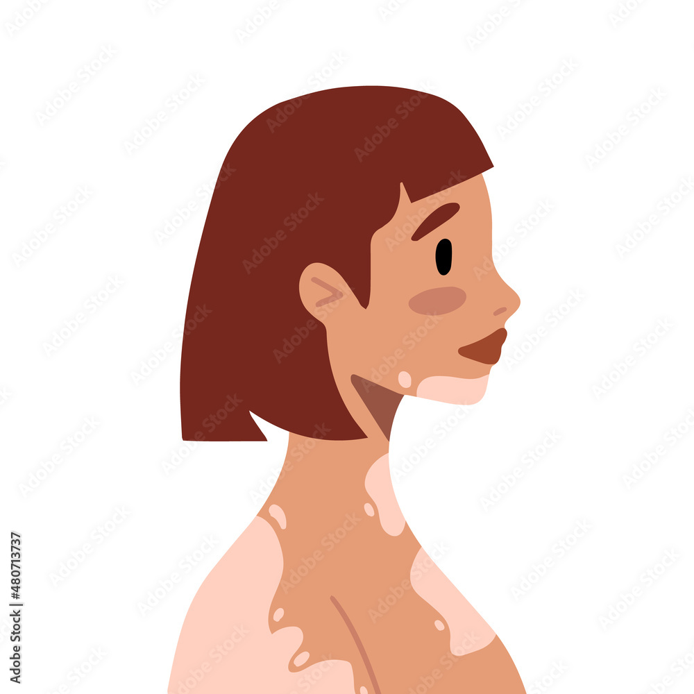 Young woman with vitiligo. Support people with chronic skin disorder. Accept your body. Beauty is diversity. Self acceptance, self love concept. Poster, banner, card international World Vitiligo Day