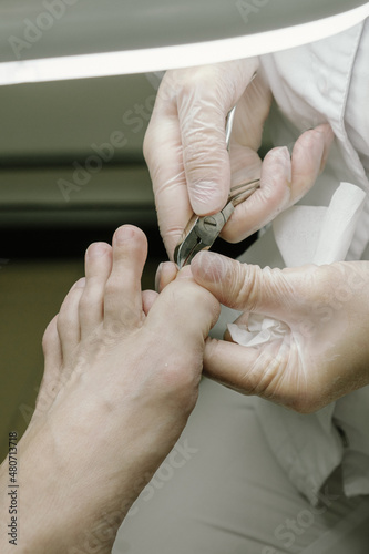 the doctor cuts the diseased nail with nail clippers under the lamp