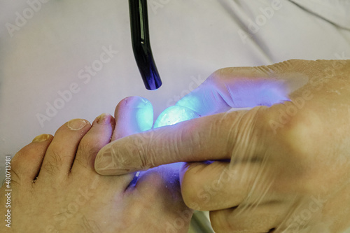 a doctor in a medical office checks a toenail for an infection