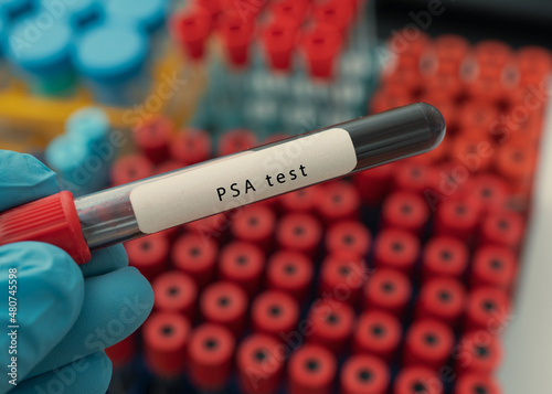 PSA test result with blood sample tube photo