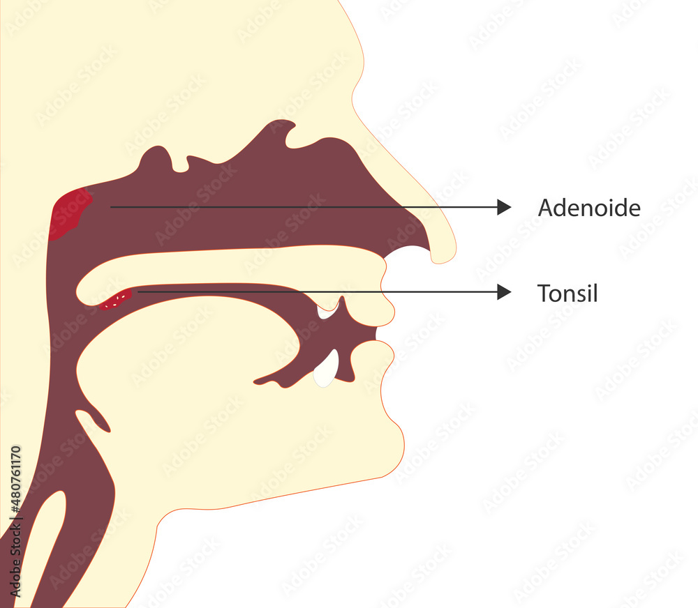 Adenoide and Tonsil inflammation. Anatomy of both structures Stock ...