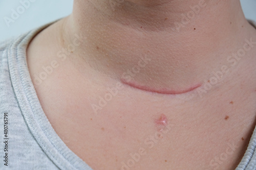 Scar on the neck. surgical wounds, removal of tumor and thyroid cancer. Red scar on the larynx, cut on the skin. Surgery and treatment Thyroidectomy, Hemithyroidectomy, Hashimoto's thyroiditis
