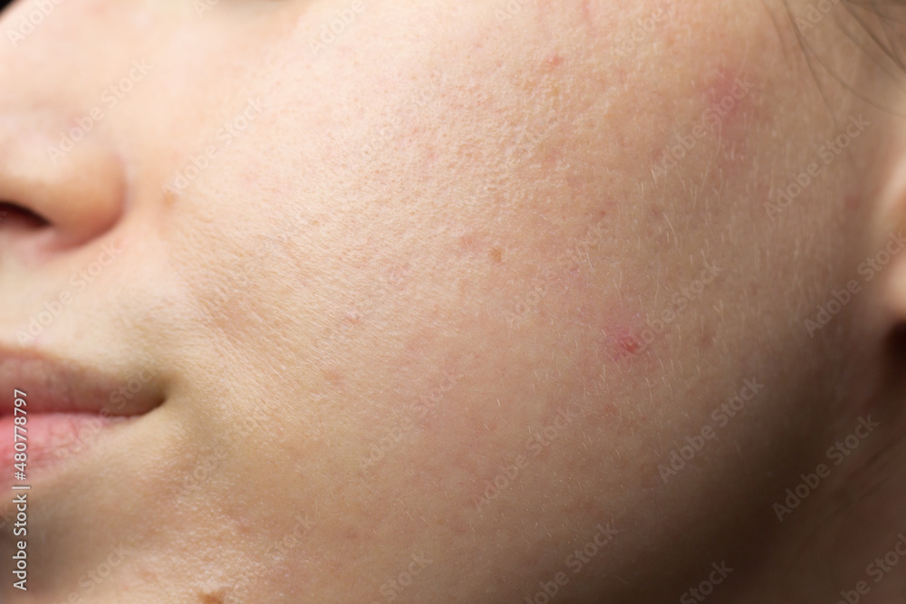 Closeup of acne-prone skin with scarring and post-inflammatory erythema after isotretinoin treatment.