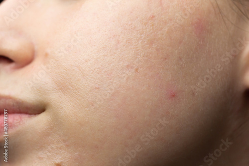 Obraz na płótnie Closeup of acne-prone skin with scarring and post-inflammatory erythema after isotretinoin treatment. w salonie