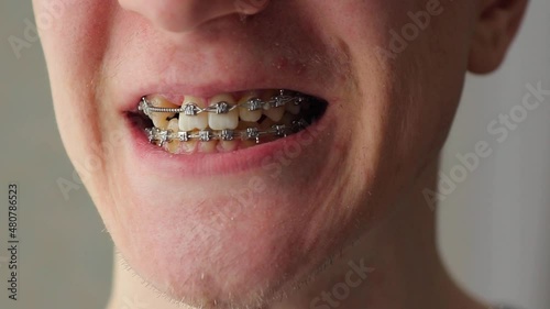 Man with crooked ugly teeth smiles with braces on teeth and turns head