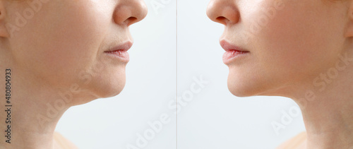 A close portrait of an aged woman before and after facial rejuvenation procedure. Correction of the chin shape liposuction of the neck. The result of the procedure in the clinic of aesthetic medicine. photo