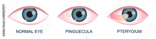Eye healthy, with pinguecula and pterygium growing onto cornea. Conjunctival degeneration. Eye disease. Human organ of vision with pathology. Vector realistic illustration. photo