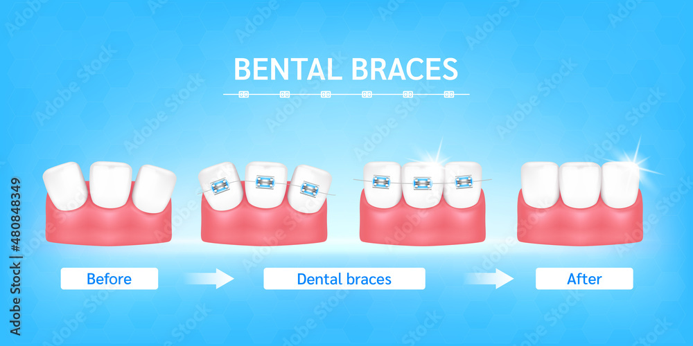 Orthodontic treatment style fashion beautiful blue before and after ...