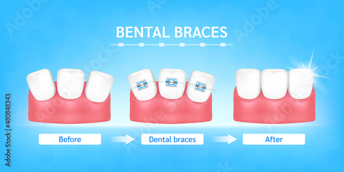Orthodontic treatment style fashion beautiful blue before and after. White teeth with metal brackets. Tooth braces isolated on a blue background. Realistic 3D vector. Dental care health concept.