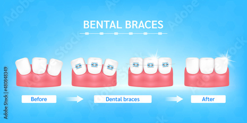 Orthodontic treatment style fashion beautiful blue before and after. White teeth with metal brackets. Tooth braces isolated on a blue background. Realistic 3D vector. Dental care health concept.