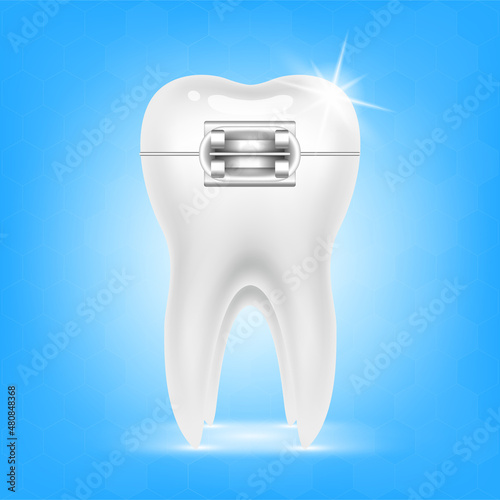 Orthodontic treatment style fashion beautiful. White teeth with metal brackets. Tooth braces isolated on a blue background. Realistic 3D vector. Dental care health concept.