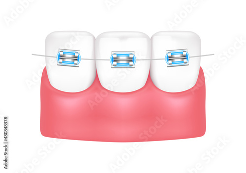 Orthodontic treatment style fashion beautiful blue. White teeth with metal brackets. Tooth braces isolated on a white background. Realistic 3D vector. Dental care health concept.