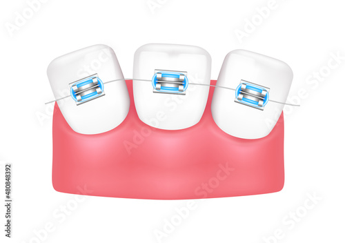 Orthodontic treatment style fashion beautiful blue. White teeth with metal brackets. Tooth braces isolated on a white background. Realistic 3D vector. Dental care health concept.