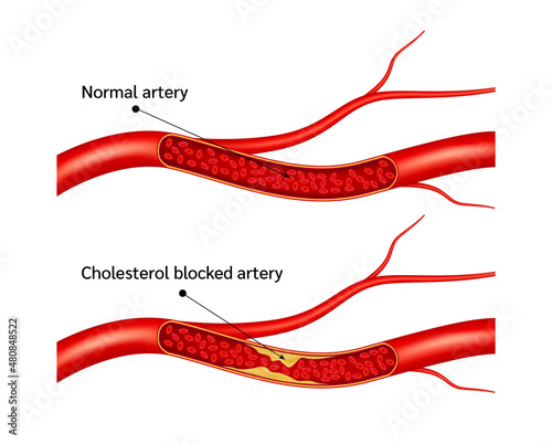 Normal blood flow and Cholesterol artery thrombosis microvascular disease. In human blood vessels. High ldl and hdl level. Arteriosclerosis blood risk. ​3D Vector illustration. photo