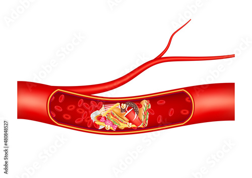 Blood vessel is blocked with fast food and hamburger. Cholesterol artery thrombosis microvascular disease. In human blood vessels. ​3D Vector illustration.