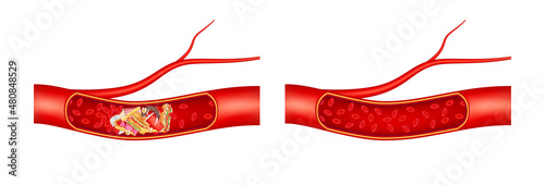 Normal blood flow and Blood vessel is blocked with fast food, hamburger. Cholesterol artery thrombosis microvascular disease. In human blood vessels. ​3D Vector illustration. photo