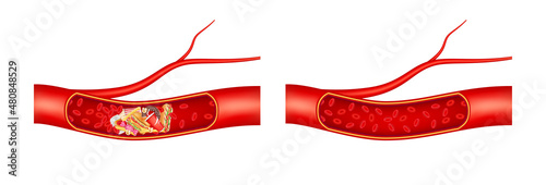 Normal blood flow and Blood vessel is blocked with fast food, hamburger. Cholesterol artery thrombosis microvascular disease. In human blood vessels. ​3D Vector illustration.
