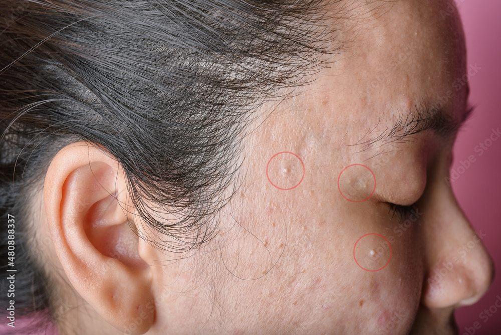 Acne pus, Close up photo of acne prone skin, Skin problem with acne