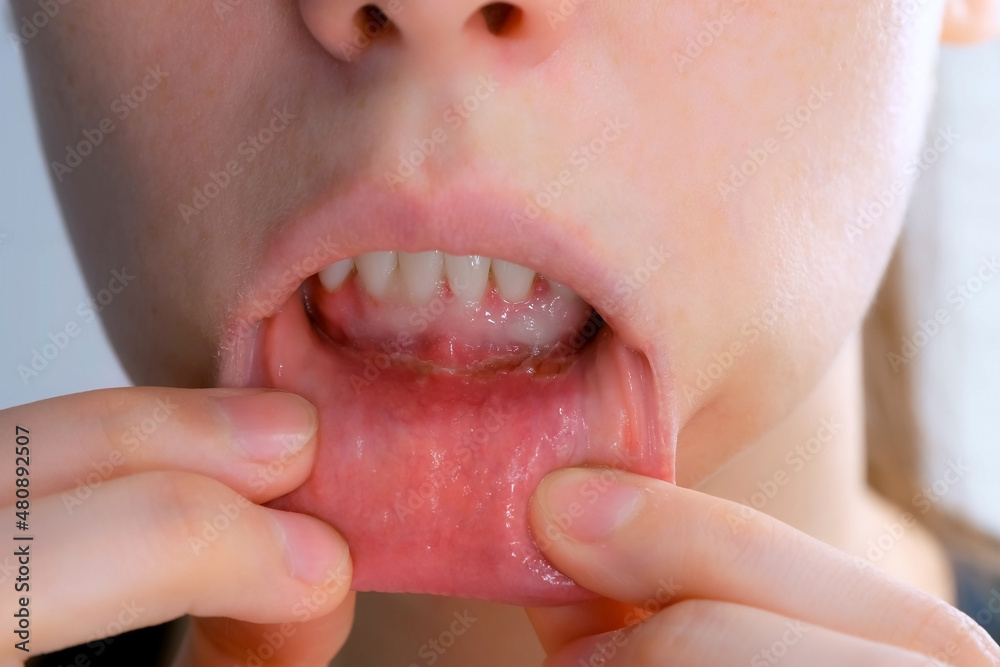 Stomatitis in woman's mouth after dental treatment, disease in the mouth. Stomatitis on the