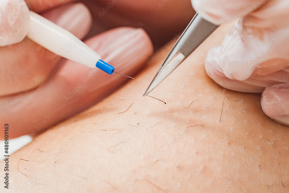 The process of permanent hair removal, using an electroepilation device and tweezers