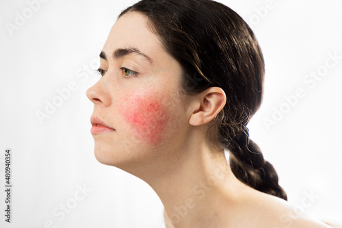 Couperose. Portrait of a young beautiful Caucasian woman with rosacea on her cheek. Isolated on a white background. The concept of cosmetology
