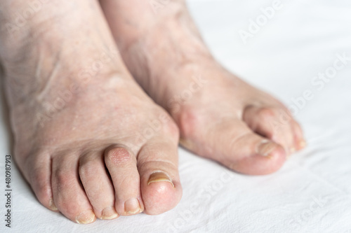 Bunions on feet of senior woman with hammer toes and dry skin over white background. Hygiene, surgery, health care, podiatrist, dermatology concepts