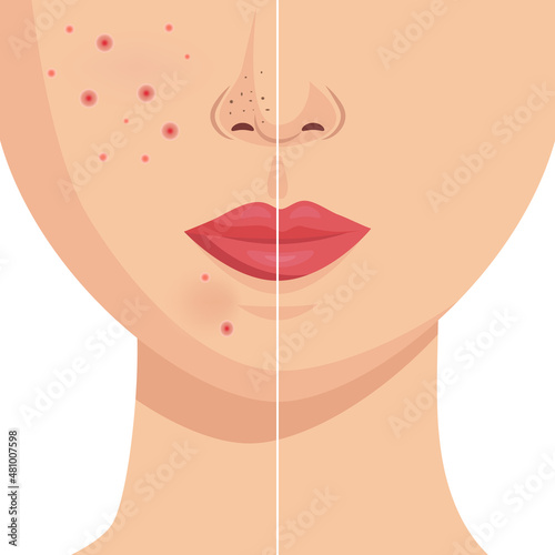 vector illustration of acne before after. skin care concept. comparison of the result. woman with problem inflamed skin. concept of dermatology, cosmetology