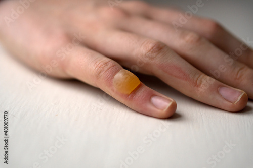 A blister from a burn on a girl s hand.