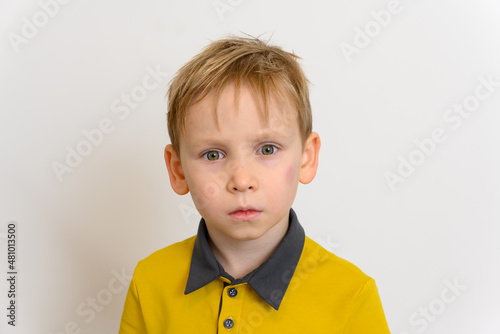 A hematoma on the face under the boy's left eye. Injury in a fall. The boy looks directly into the camera