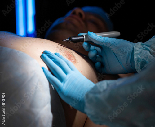 Doctor plastic surgeon makes marks with a felt-tip pen for plastic surgery to correct male breast  close-up. Gynecomastia