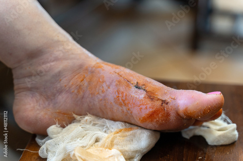 Human leg after sanitizing and treatment, horrible scar from trauma or surgery. Result of tight shoes, deformity great toe or first metatarsophalangeal joint, hallux valgus or bunion. Selective focus. photo