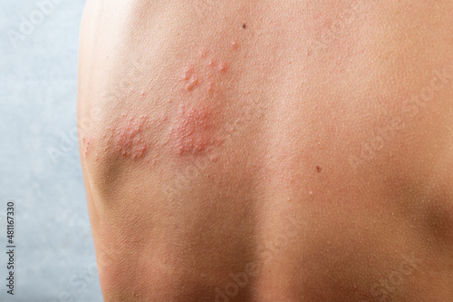 chickenpox rash. Shingles, varicella-zoster virus. skin rash and blisters on body. Skin infected Herpes zoster virus. Herpes Virus on body. urticaria rash. atopic dermatitis photo