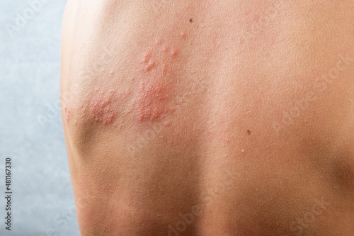 chickenpox rash. Shingles, varicella-zoster virus. skin rash and blisters on body. Skin infected Herpes zoster virus. Herpes Virus on body. urticaria rash. atopic dermatitis