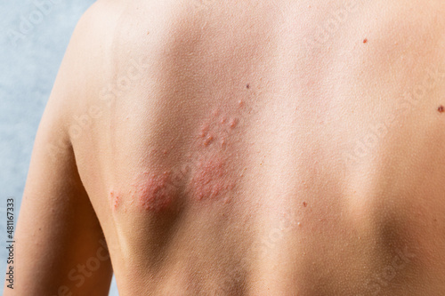 chickenpox rash. Shingles, varicella-zoster virus. skin rash and blisters on body. Skin infected Herpes zoster virus. Herpes Virus on body. urticaria rash. atopic dermatitis