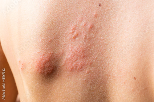 chickenpox rash. Shingles, varicella-zoster virus. skin rash and blisters on body. Skin infected Herpes zoster virus. Herpes Virus on body. urticaria rash. atopic dermatitis photo