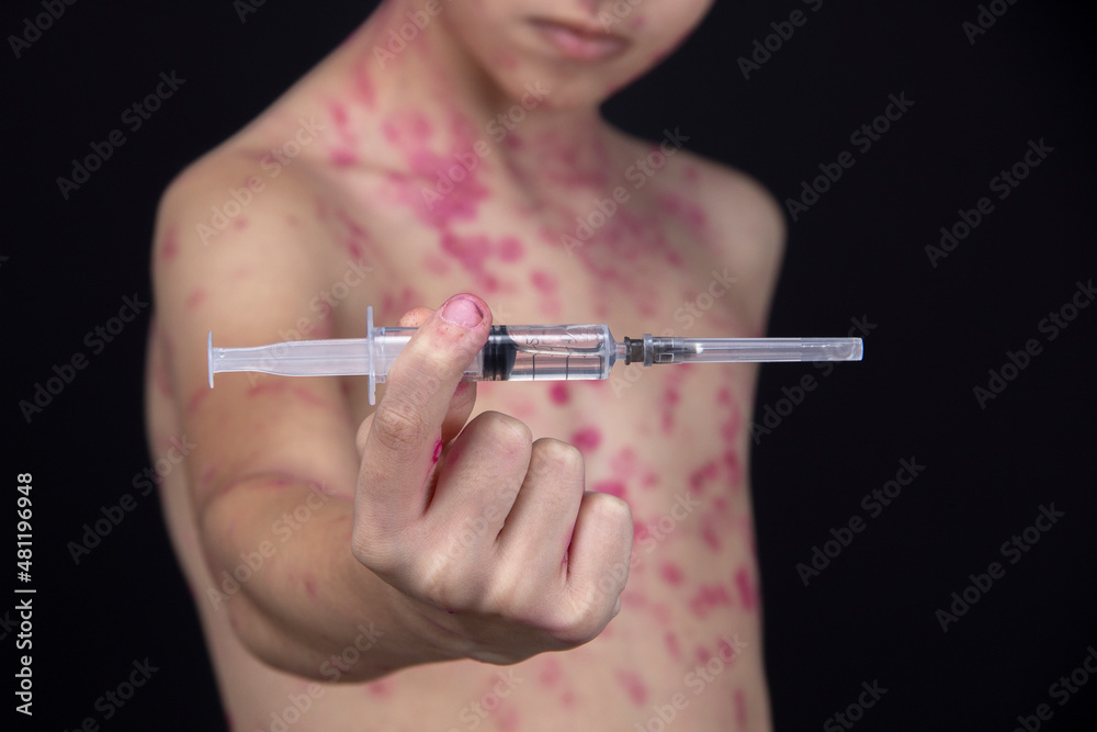 A boy is holding a syringe with a vaccine for the virus in his hand. A boy is holding a syringe with a vaccine for the virus in his hand.